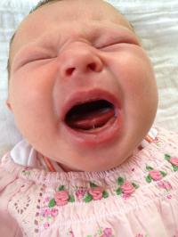 Tongue tie Surgery Parramatta