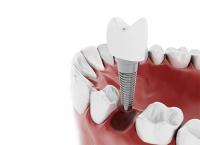 Dental Implants Bundoora