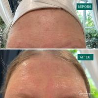 Micro Needling / Skin Needling