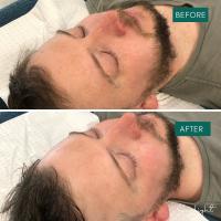 After a Deluxe Facial